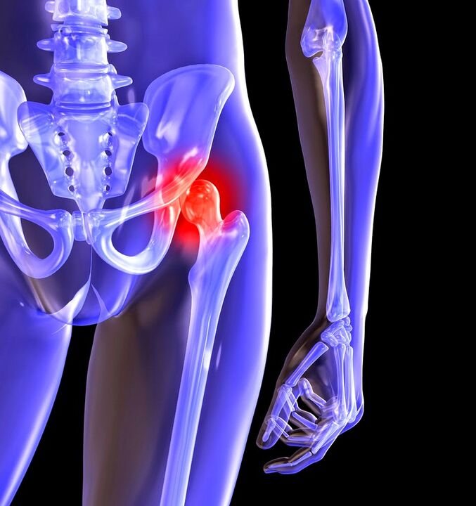 Verformen Sie die Arthrose des Hüftgelenks
