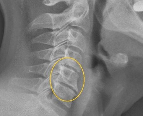 Osteochondrose der Halsspalte auf einem Radius X