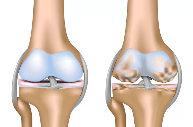 Verformen Sie die Arthrose des Kniegelenks