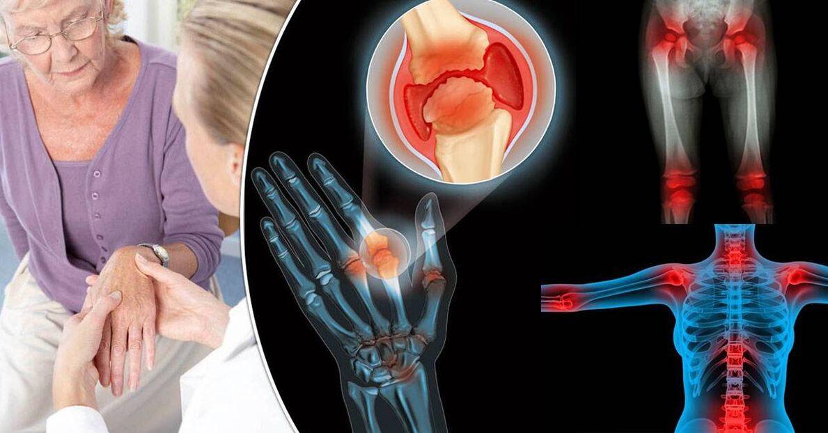 Was ist Arthrose